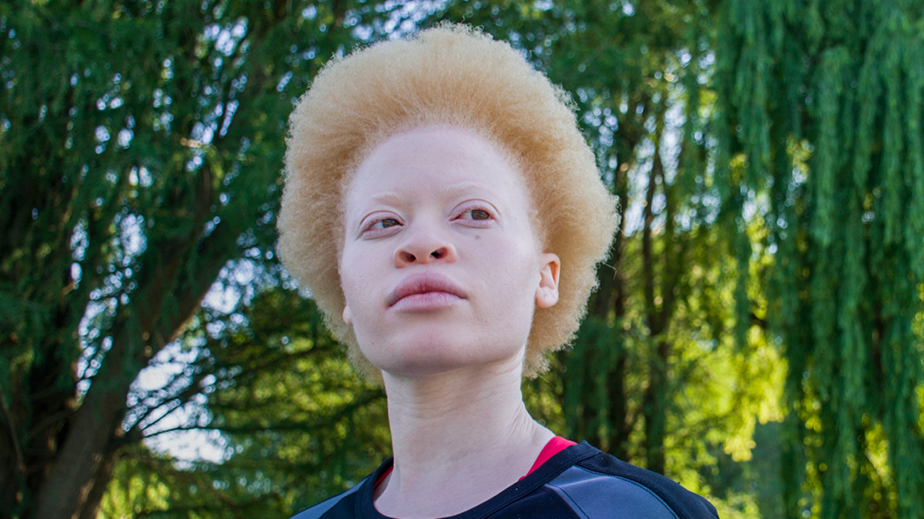 Where Is Albino Representation?